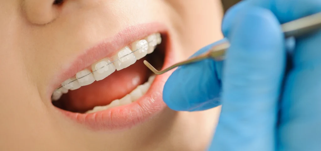 orthodontie adolescent bagues puteaux nanterre Orthodontie adolescent wongeczowski