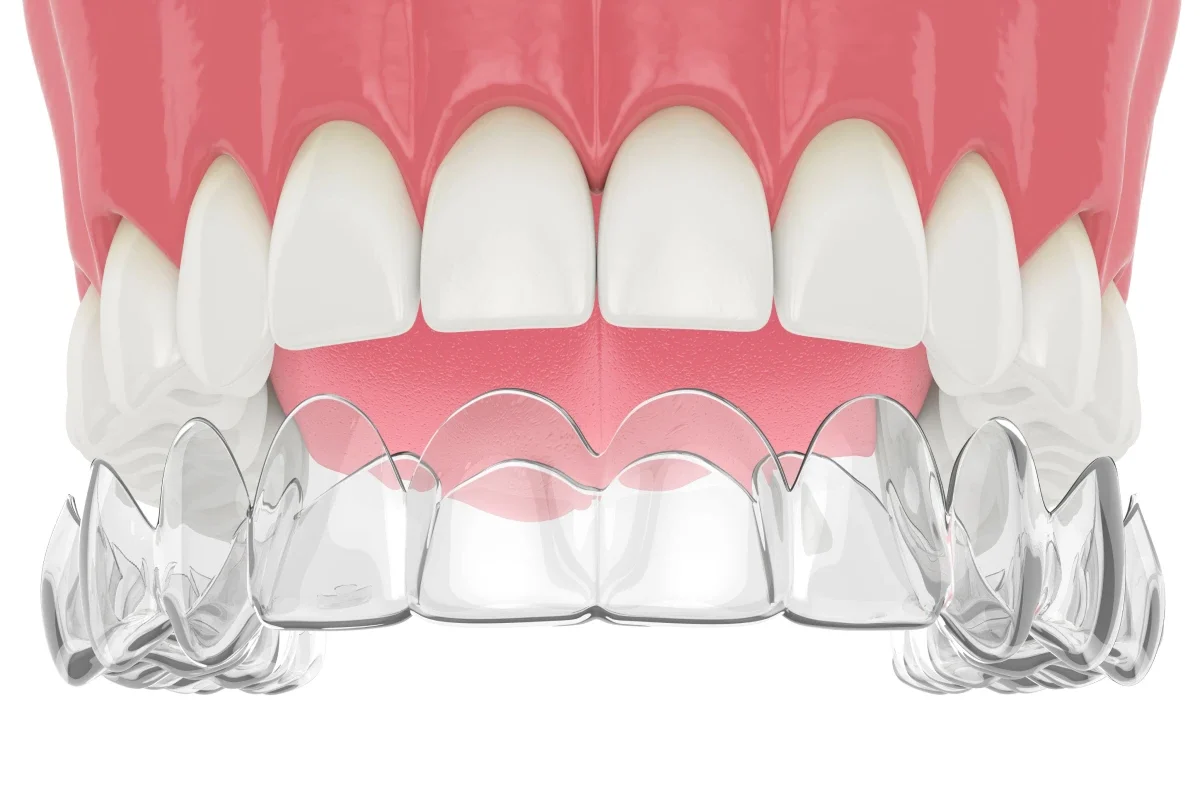 orthodontie aligneur invisible contention