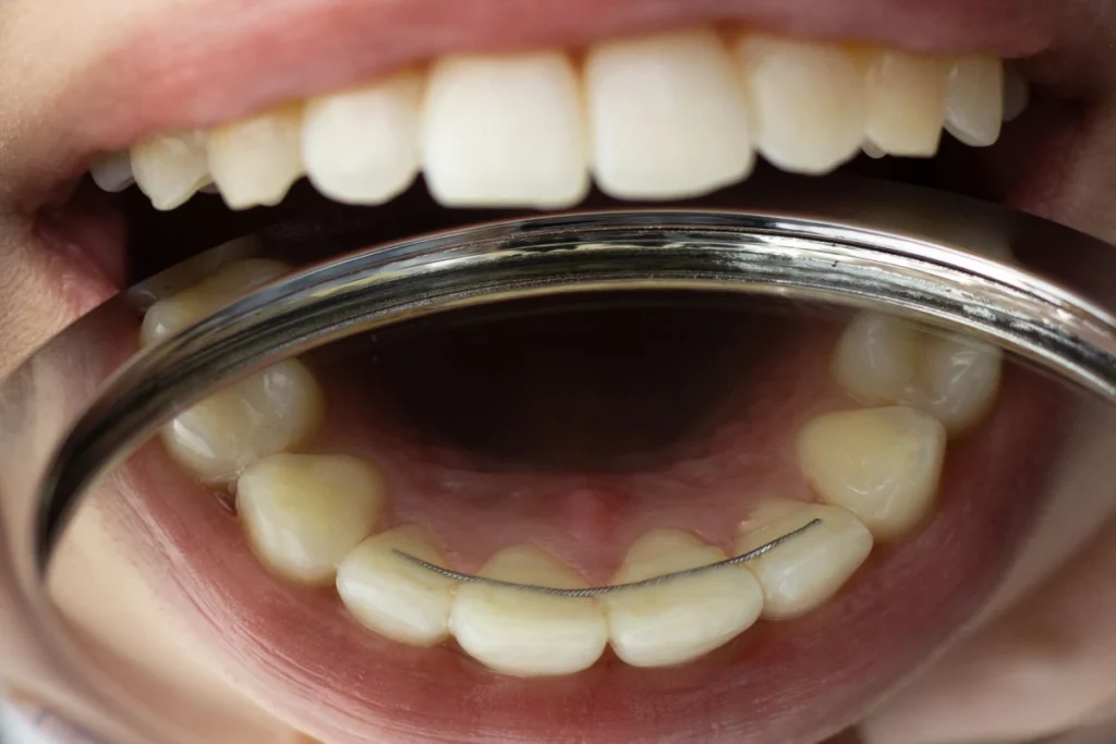 orthodontie contention fil fixe