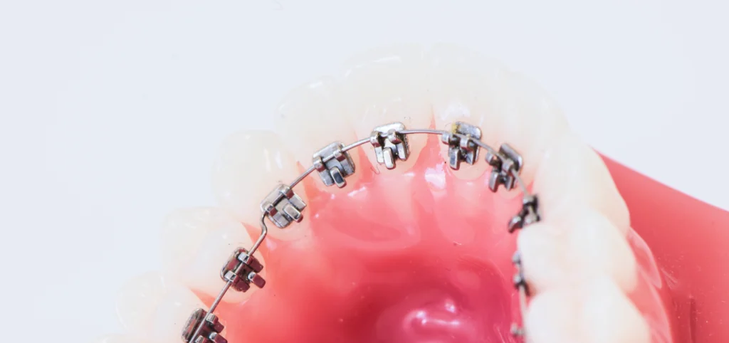 orthodontie linguale puteaux consultation orthodontiste Orthodontie adulte wongeczowski